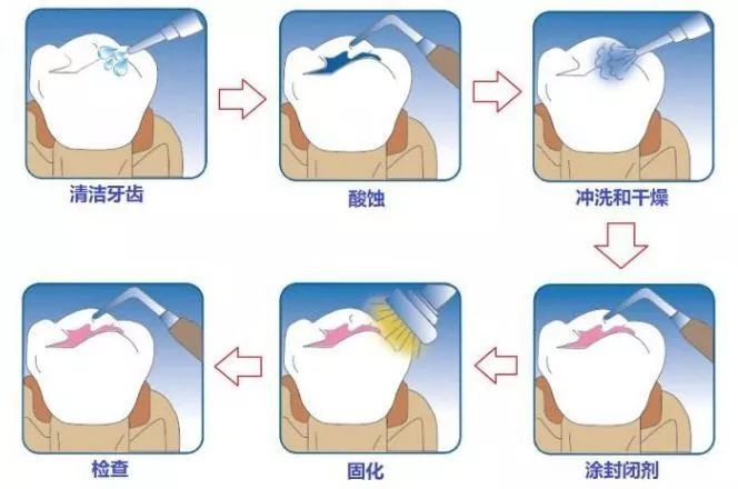 今年將定向為龍湖區5所小學或校區的二年級適齡兒童免費實施六齡牙窩